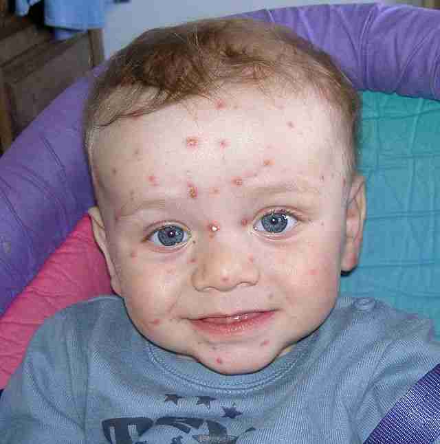 Remembering the Pre-Vaccine Era: The Diseases of Childhood